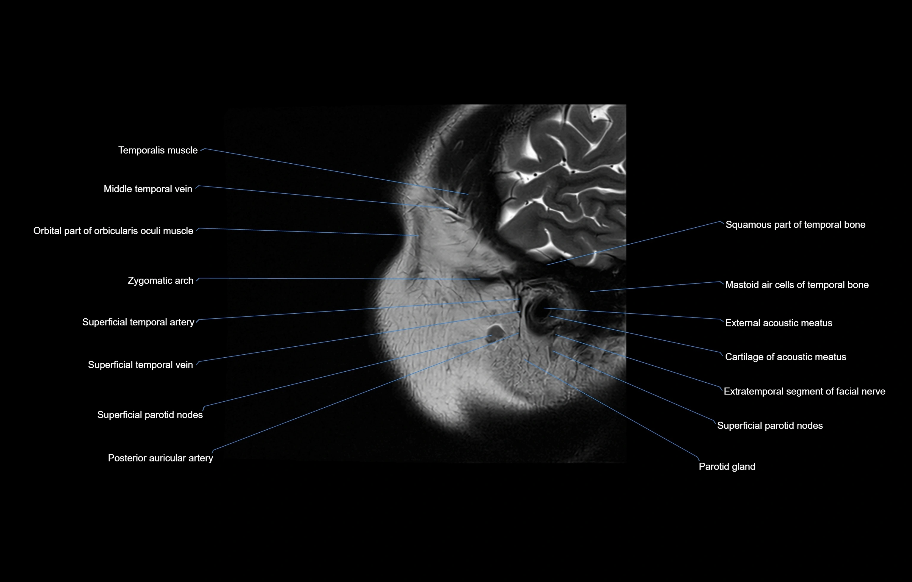 paranasal sinuses(PNS) MRI coronal  cross sectional anatomy 3T radiology  image-img-00001-00024.webp